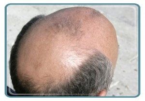 Say No to Baldness !