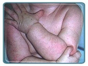 Eczema